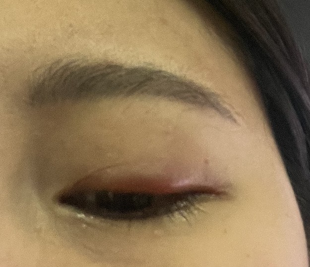 콩다래끼 제거 후기/콩다래끼 제거 방법/강남 콩다래끼 수술 안과 추천