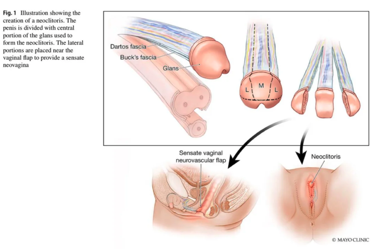  성전환 수술 질 성형술 신경 보존 음핵 재건 Neoclitoris 최신 기법