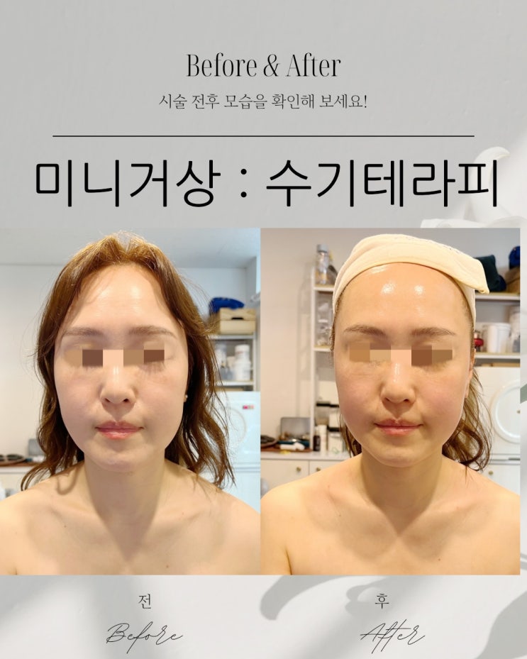  동래피부관리 윤곽관리, 팔자주름 눈밑처짐 고민이라면?