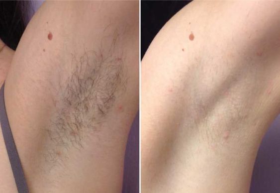  신촌피부과 여름철 필수 케어! 레이저 제모, 다한증 보톡스로 산뜻한 준비 시작