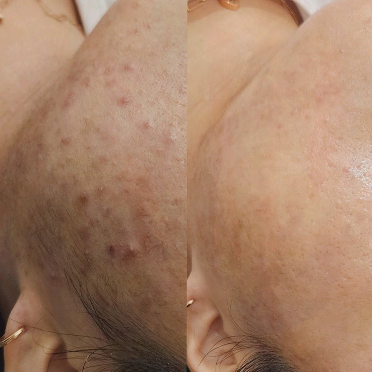  [아비에 피부&왁싱 대전점] 맞춤형 피부 관리와 체형 관리, 대전피부관리