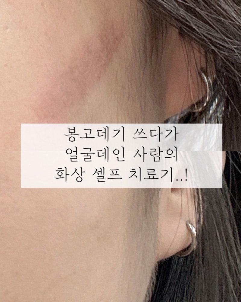 봉 고데기 화상 셀프 치료 | 미보 연고, 후시딘 | 하이맘번 밴드, 닥터헬퍼 밴드 | 4개월 뒤 상....