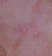 헤르페스 2형 초기증상, '이것'만 알면 됩니다 (+찐후기)