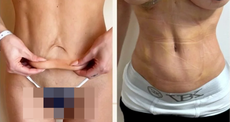  복부 성형 재수술, 상복부 처짐 해결을 위한 ‘리버스 복부성형술’