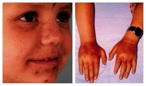  적혈구 원형(Erythropoietic Protoporphyria) 및 X-연관 원형동물증(X-linked Protoporphyria)