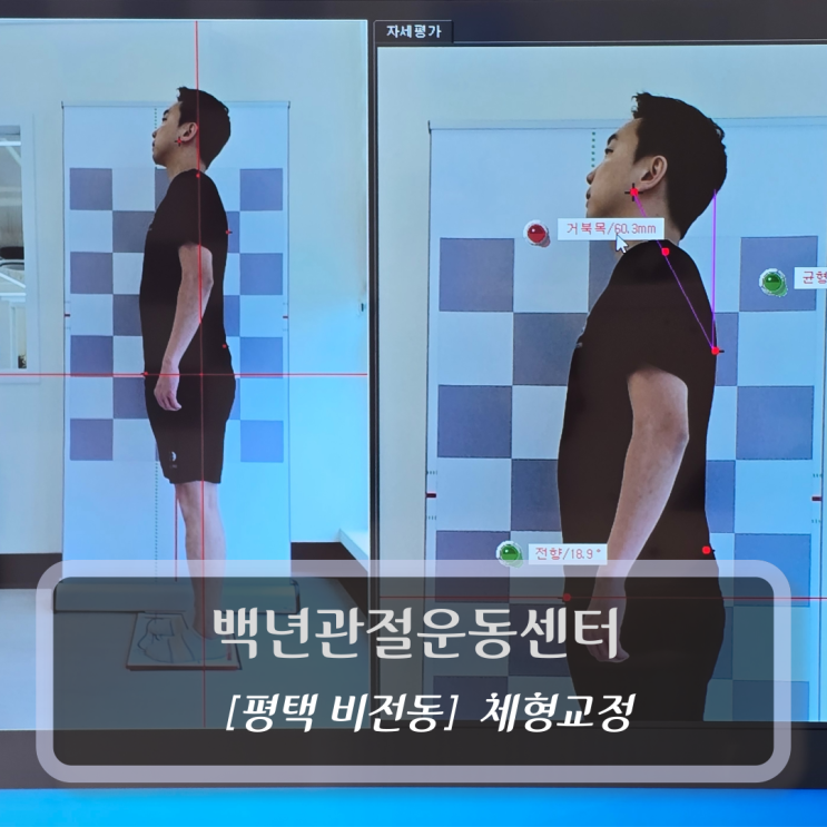  평택체형교정 :: 백년관절운동센터 평택점 후기