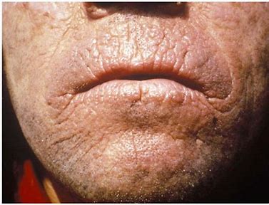 피부 포르피린증(Cutaneous Porphyrias) 이란?!