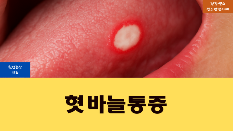  혓바늘 통증 원인 증상 및 치료