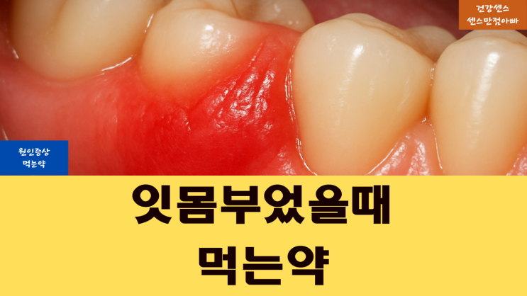  잇몸 부었을때 원인 증상 및 먹는약