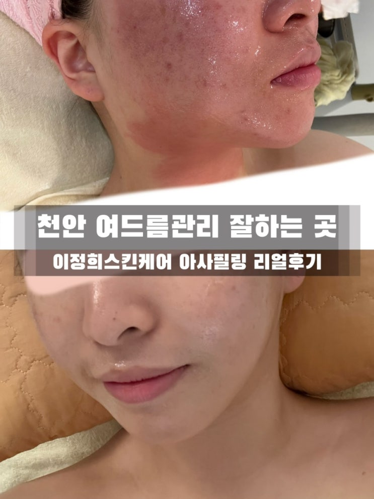  천안 여드름관리 잘하는 곳｜이정희스킨케어 아사필링 리얼후기