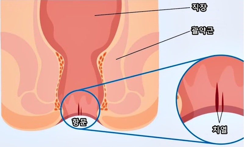 항문 찢어짐 치열 증상 원인 자연치유 마데카솔 후시딘 연고 낫는법