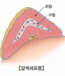 부신 종양 - 갈색세포종