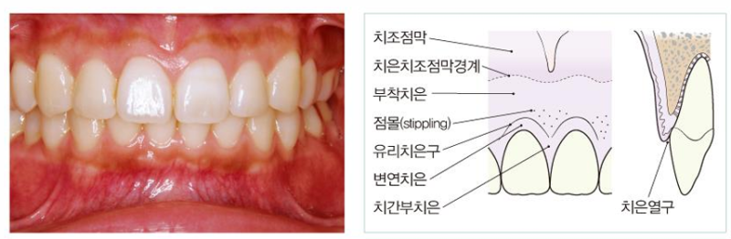 [치주학] 치주조직 총정리 | 치은 구성종류 구조 변연치은 | 치주인대 샤피섬유 | 백악질 | 상아질 | 치조골 | 연령에 따른 ...