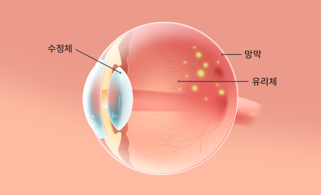  루테인의 배신, 더 이상 사먹지 마세요.