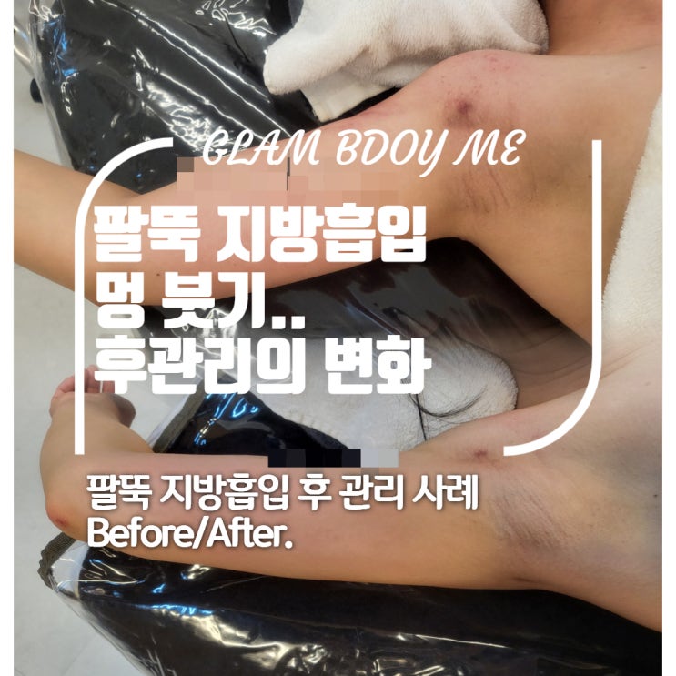  팔뚝 지방흡입 붓기 관리 후기 (2주차 ~ 6주차)