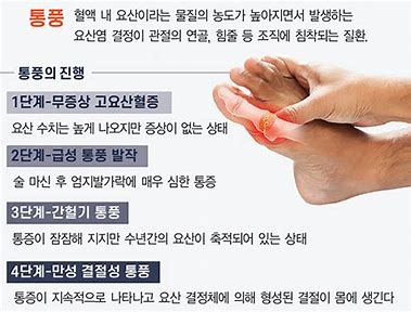 통풍- 고요산혈증 이란?!