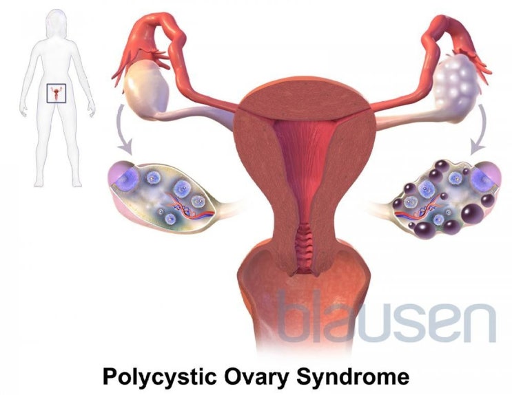 다낭성 난소 증후군(PCOS)(고안드로겐 만성 무배란; 스타인-레벤탈 증후군)