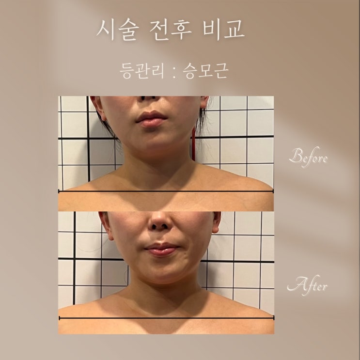  부산 비본스킨앤바디 신부관리꽃 승모근 관리