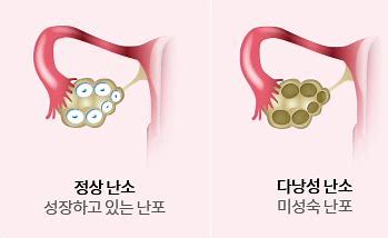 '연간 8회 이하'…월경 불규칙하면 다낭성난소증후군 검사해야