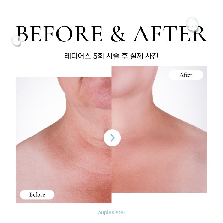  상암동피부과 리쥬란, 샤넬주사보다 레디어스가 좋은 점은?