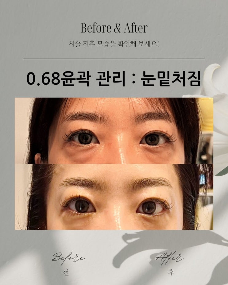  동래피부관리 :눈밑 주름  뚜렷한 눈매 만들기