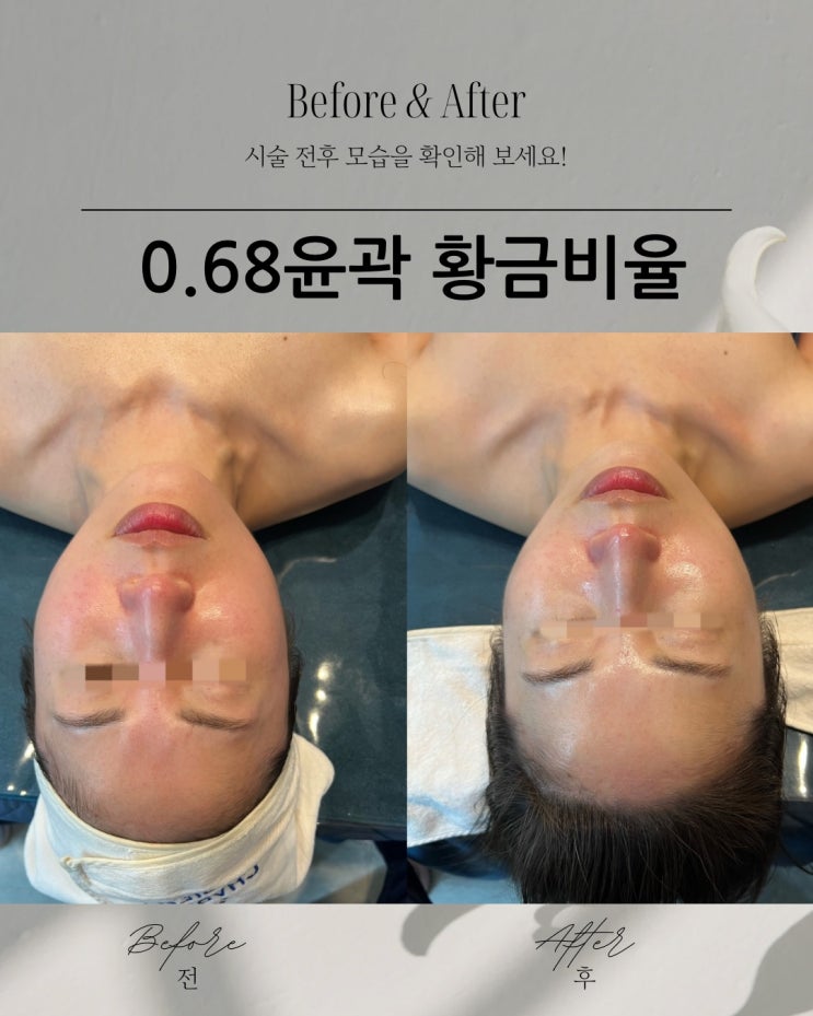  부산피부관리 : 윤곽관리 광대축소 얼굴 작아지는 황금비율
