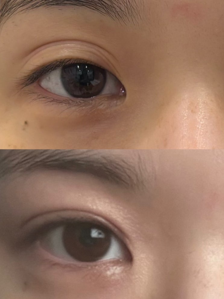  겹쌍꺼풀, 이제 고민하지 마세요! 아미뷰티 플라즈마 눈매교정으로 해결!