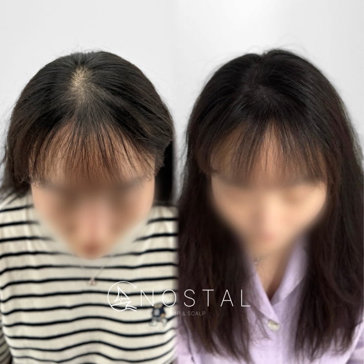  모발이식 없이 탈모 커버? 요즘은 대전두피문신이 대세!