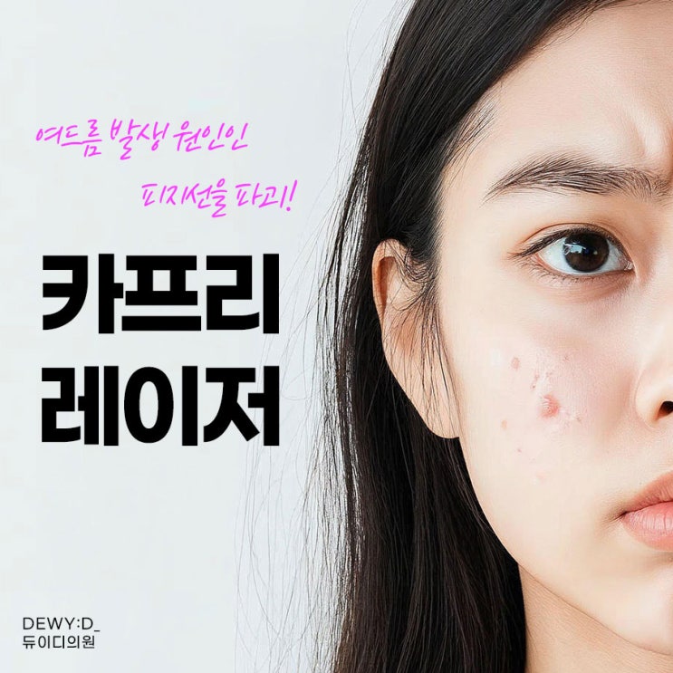  신사역 여드름치료, 카프리 레이저로 피부 밸런스를 잡다