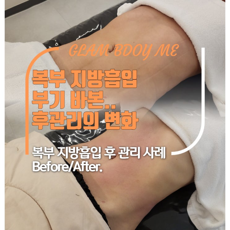  복부 지방흡입 붓기관리 (3주 차 - 6주 차) B&A