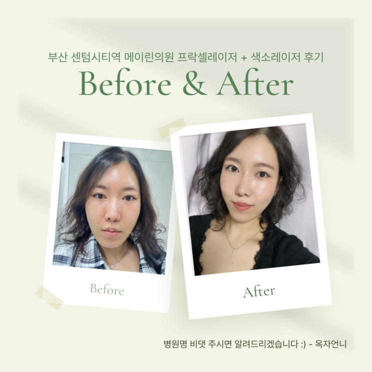  부산 센텀시티역 근처 프락셀레이저와 색소레이저(목주름, 잡티) 내돈내산 시술후기