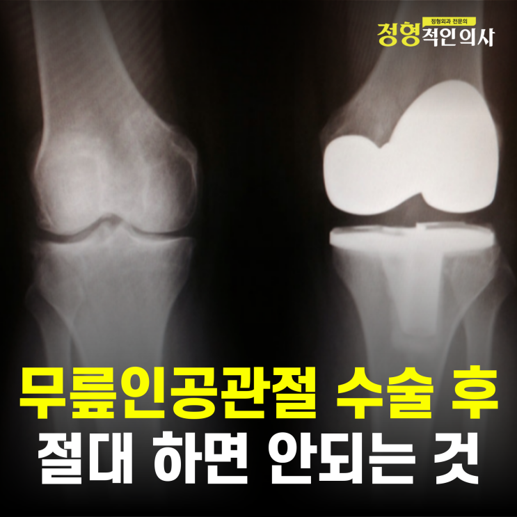  모르고 하면 큰일 납니다! 인공관절 수술 후 절대 금지 행동 3가지(의사 작성)