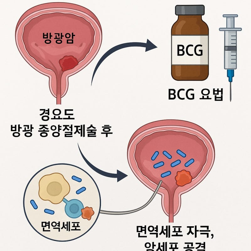 방광암 치료, BCG는 왜 맞아야 하나요?– 경요도 방광종양절제수술 후 BCG 요법 완전 정리