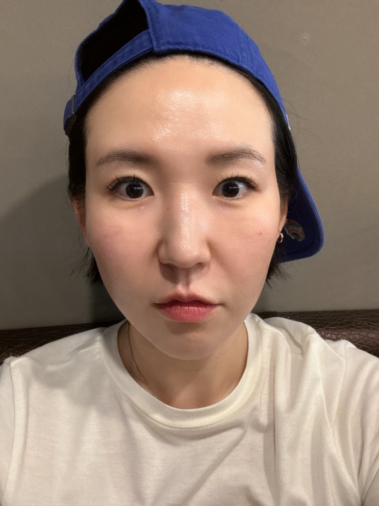  피코슈어 프락셀 + 쥬베룩 해봤더니? 모공이랑 피부결 미쳤다.