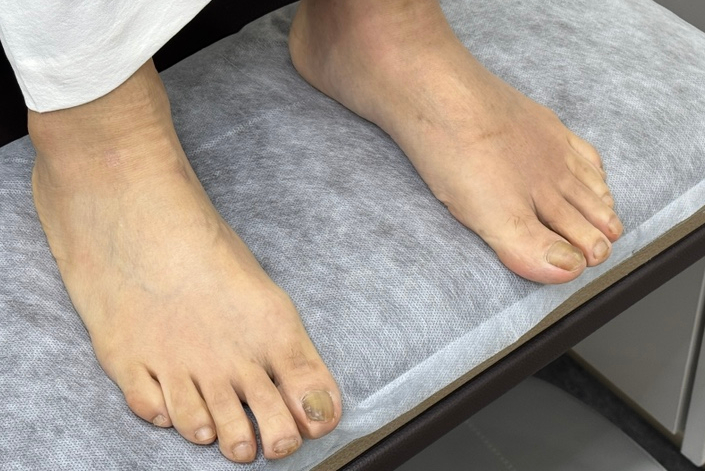  은평구발톱무좀 고민? 지축이엠365손발톱관리센터 후기