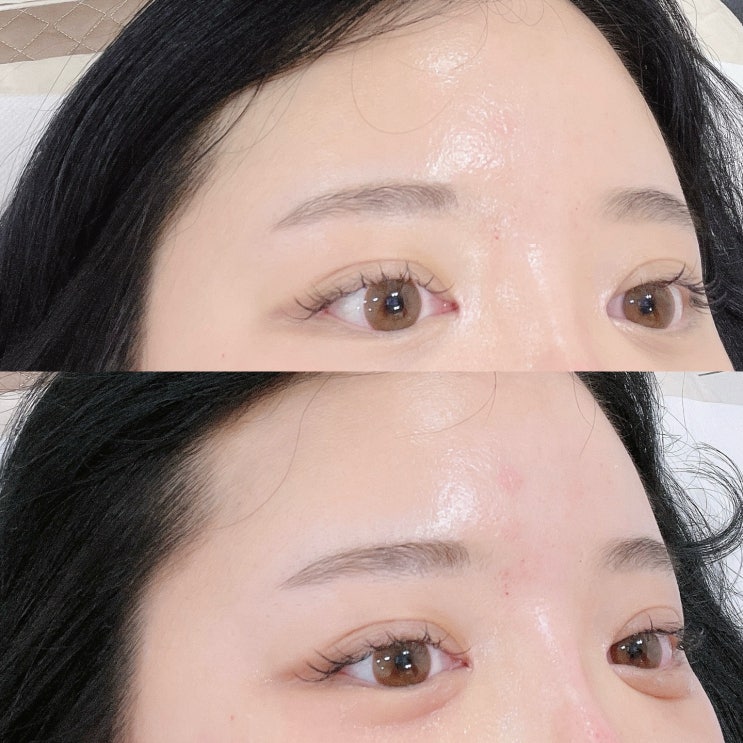  대구눈밑꺼짐 칙칙한 다크써클 관리 아미뷰티 시크릿셀 후기