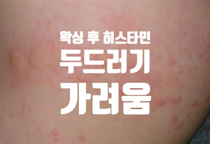  아쿠아왁싱에서 알려주는 왁싱 후 두드러기 처럼 올라오는 히스타민 반응