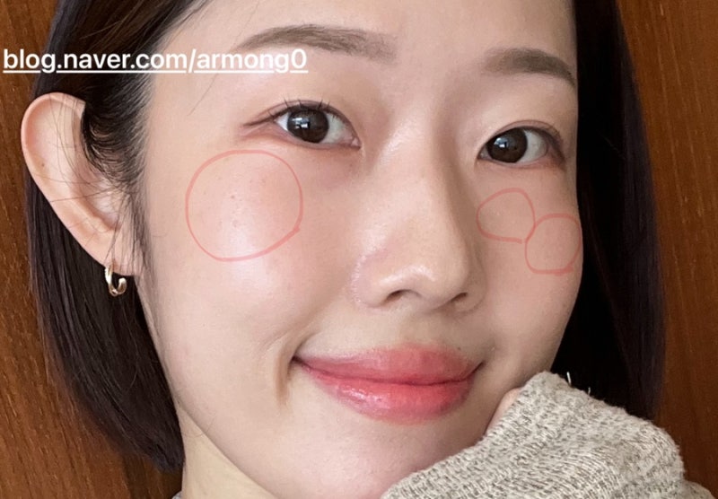 편평사마귀 제거 후기 관리 비용 통증 실비보험
