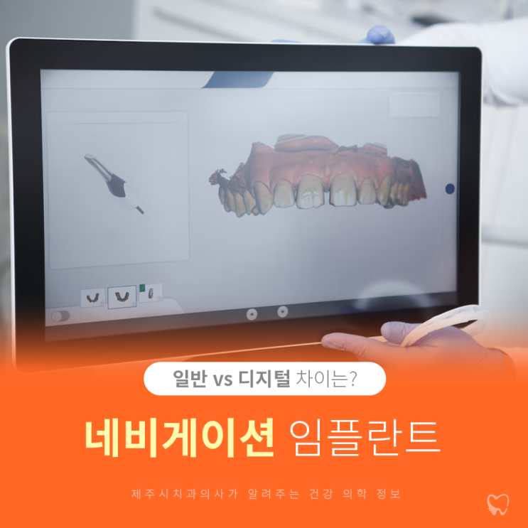  제주시치과 디지털임플란트 어떤 경우에 하면 좋나요