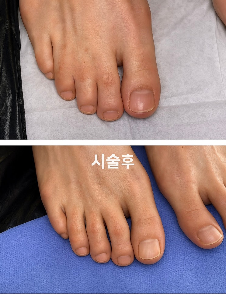  발가락 합지증 반영구 타투 교육과정, 디테일이 만드는 큰 자신감
