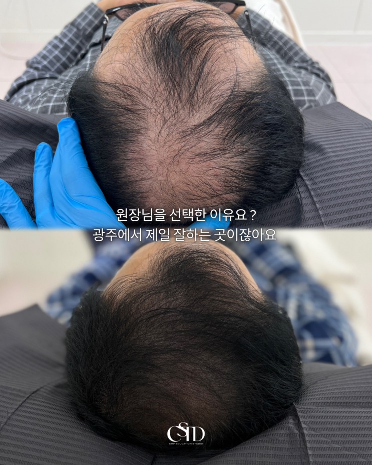  광주 정수리 탈모 진단 방법과 대처방법 공유합니다.