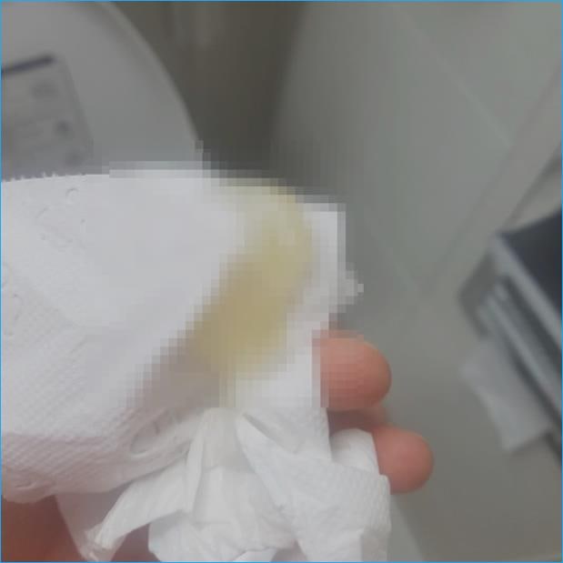 냉 노란색 이건 캔디다 질염 맞습니다 마포 마포역 산부인과