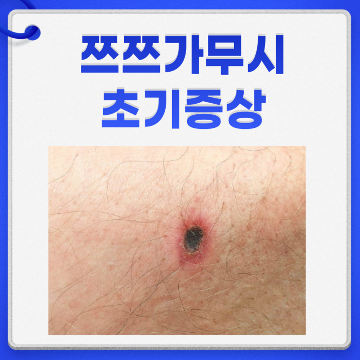 쯔쯔가무시 초기증상 진드기 물린자국 이유없는 고열?