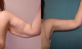  팔 처짐 고민 끝! 팔 리프팅(Arm Lift) 수술 완전 정리