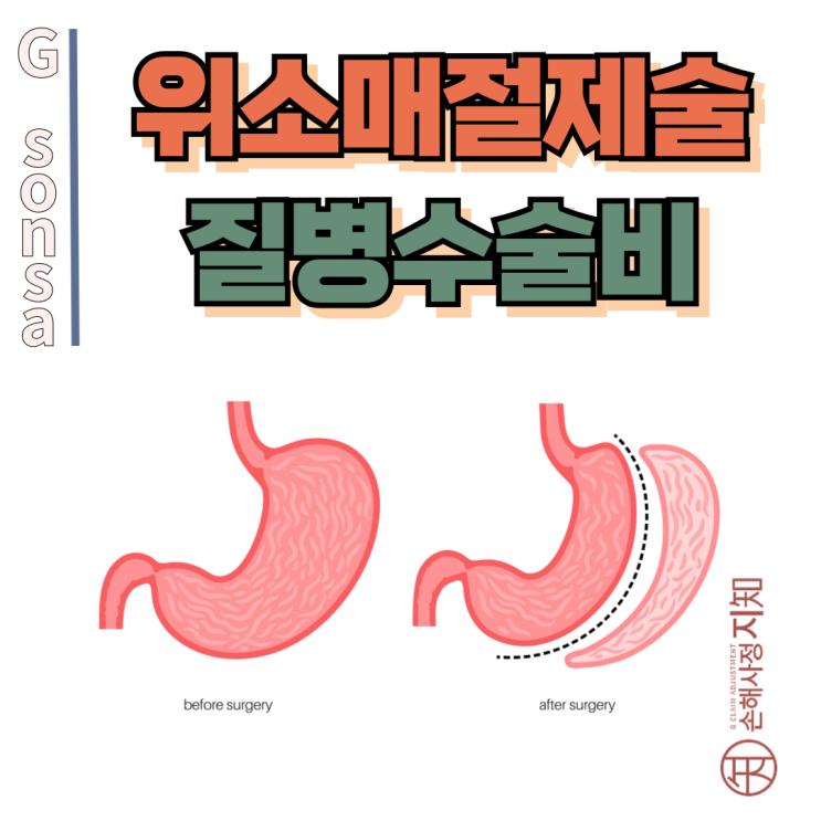  위소매절제술 보험금, 당뇨 치료 목적이면 받을 수 있어요! - [조정례, BoDa]