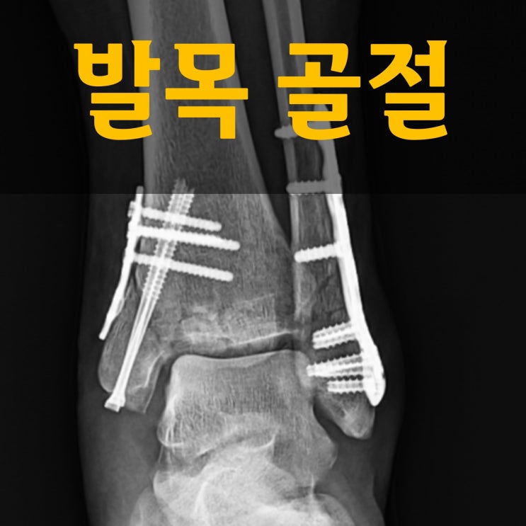  발목골절 기간 식단 궁금한 내용 정리