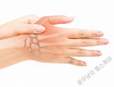 손가락 척골 측부 인대 염좌