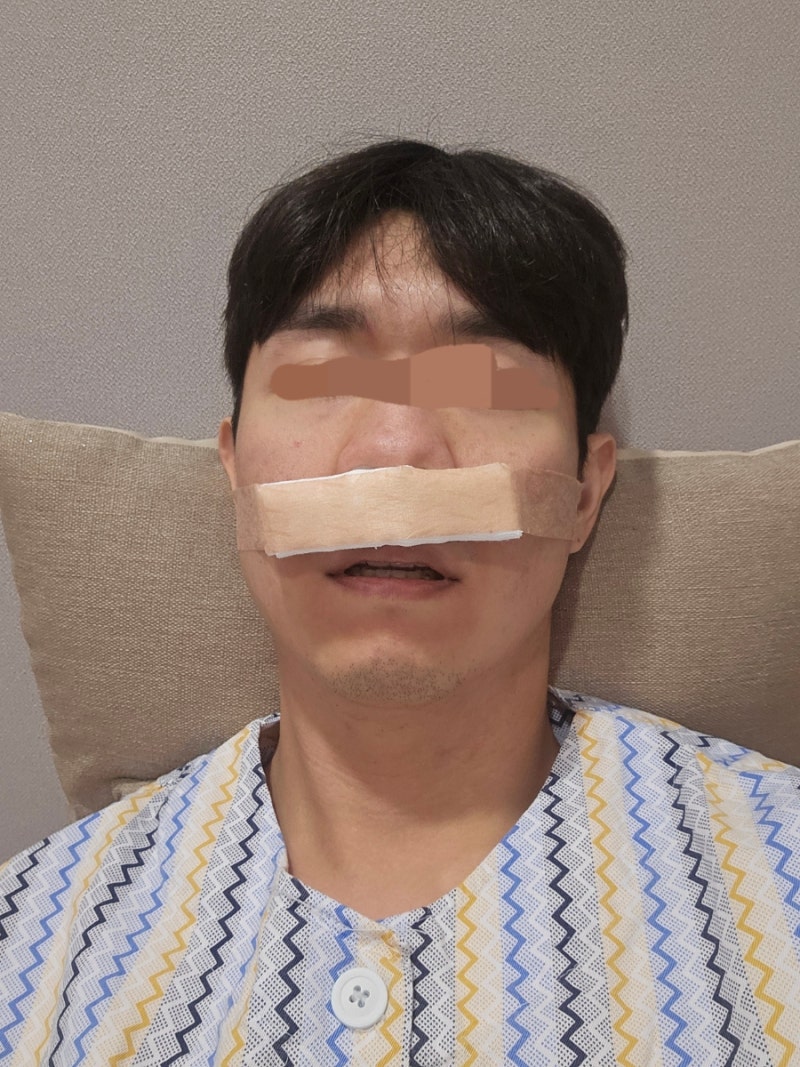 비중격만곡증 및 고주파비염 수술 후기