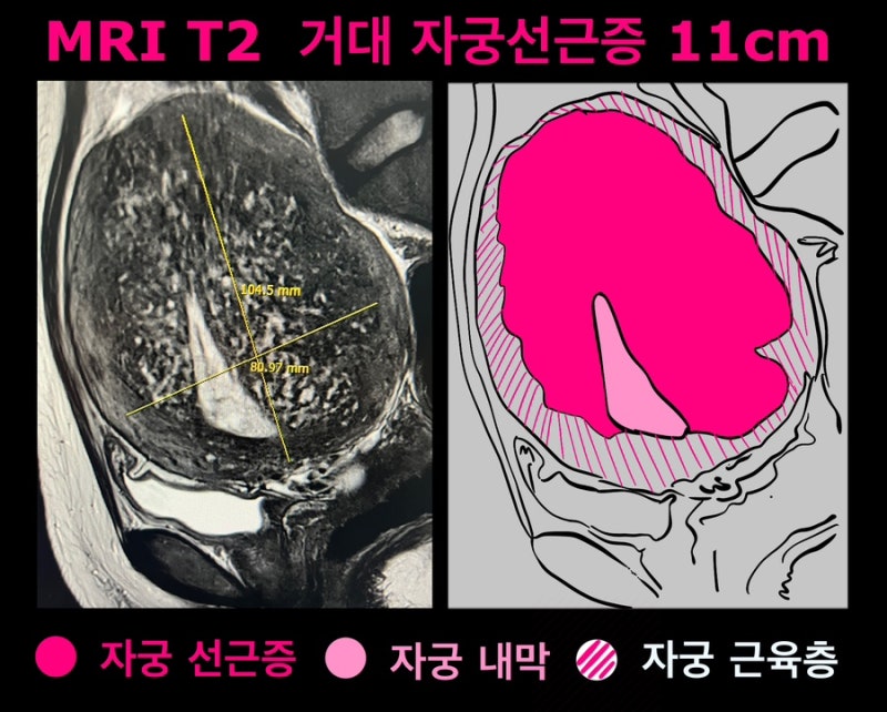 거대자궁선근증