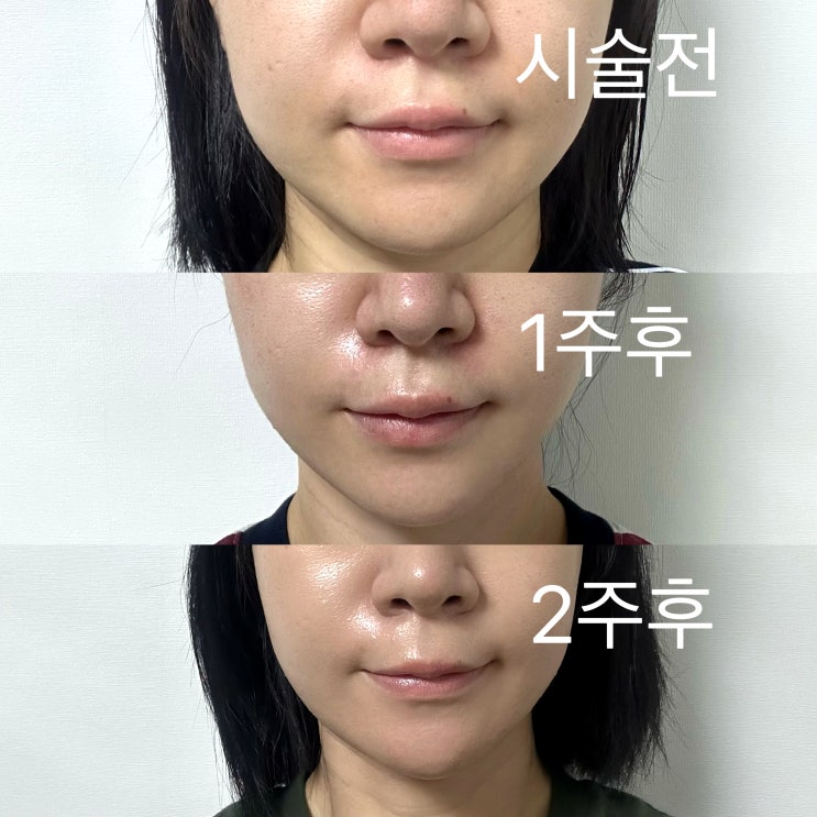  침산동 피부과 이영애 리프팅 덴서티 하이 600샷 가격 효과 후기